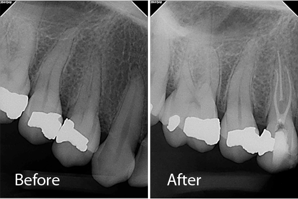 Root Canal Premolar 3 Canals - Before and After X-ray