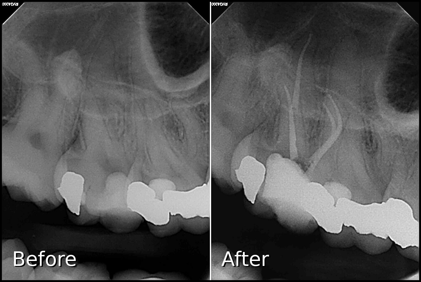 Root Canal Molar Case 3 - Before and After X-ray