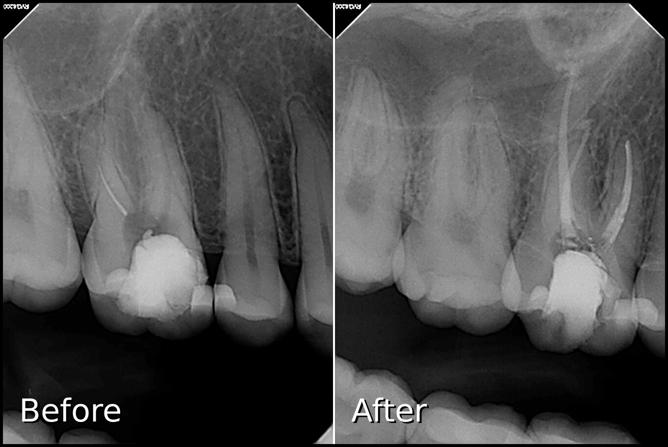 Separated File Removal and Root Canal Molar - Before and After X-ray