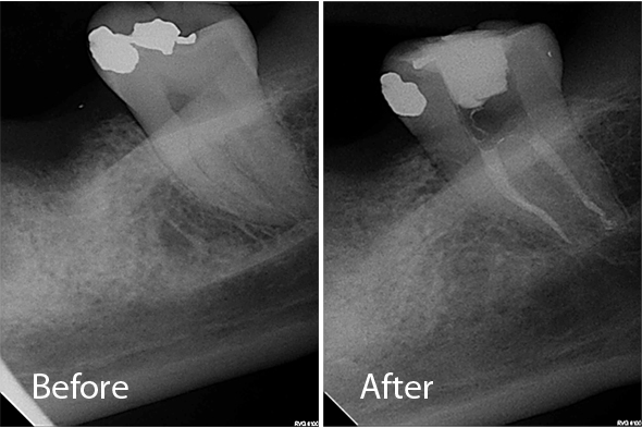 Root Canal Molar - Before and After X-ray