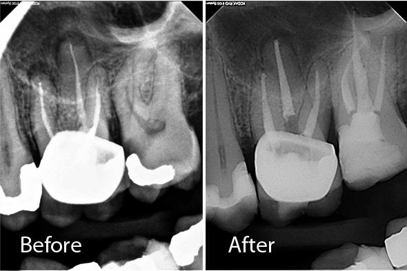 Retreatment Molar - Before and After X-ray
