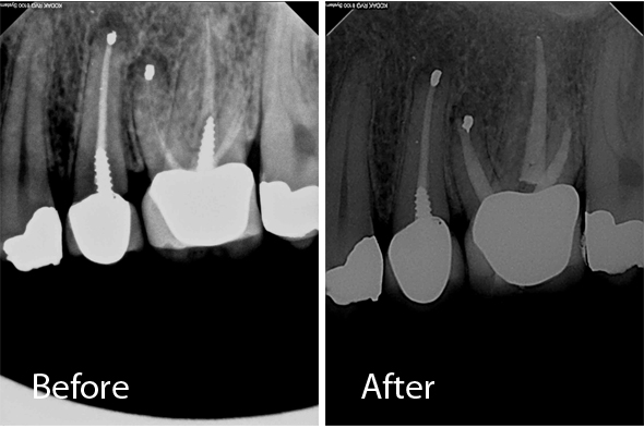Retreatment Molar and Post Removal - Before and After X-ray