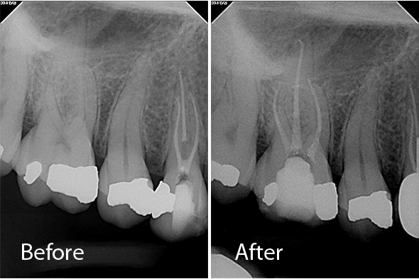 Root Canal Molar Case 2 - Before and After X-ray