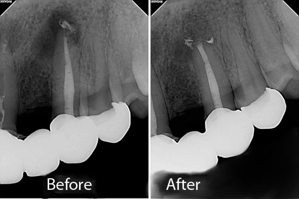 Apicoectomy Surgery - Before and After X-ray