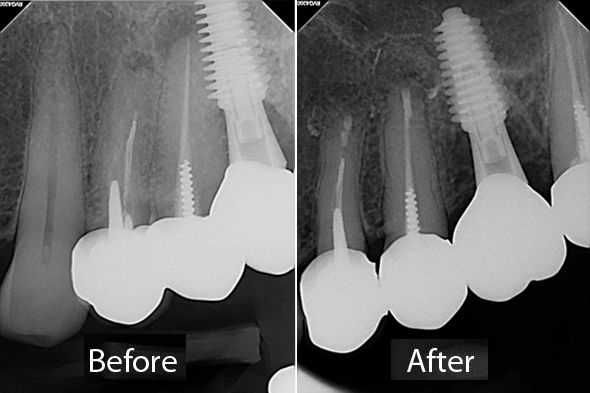 Apicoectomy Surgery Case 2 - Before and After X-ray