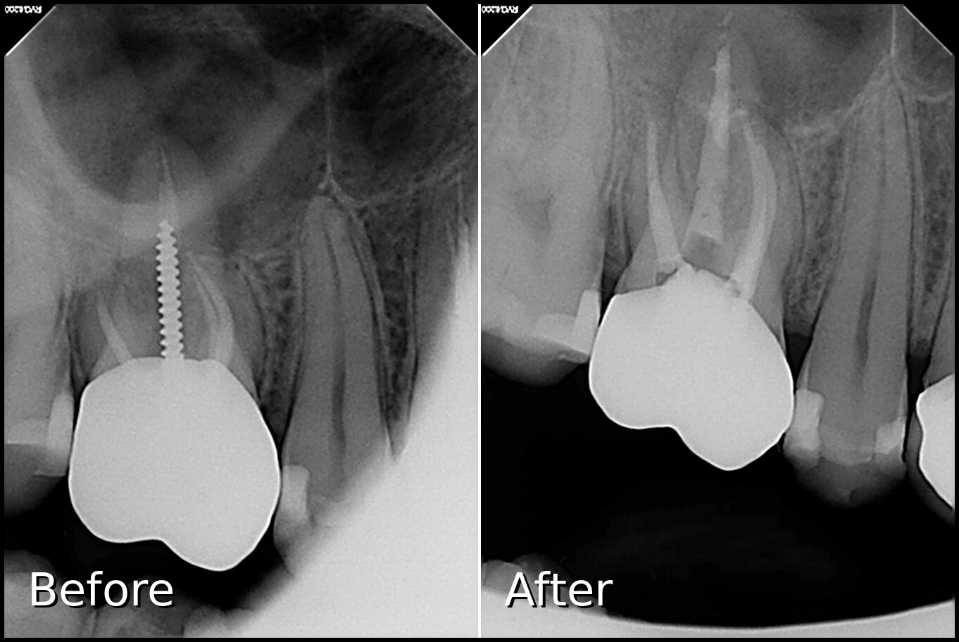 Root Canal Retreatment - Before and After X-ray